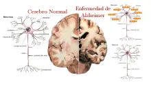 Comparación entre un cerebro sano y uno afectado por Alzheimer mostrando las áreas dañadas