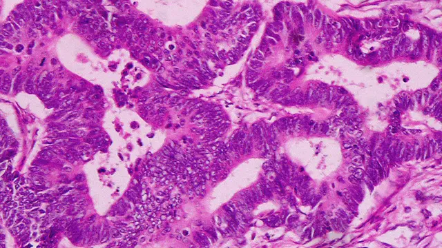 Imagen adenocarcinoma de pulmón